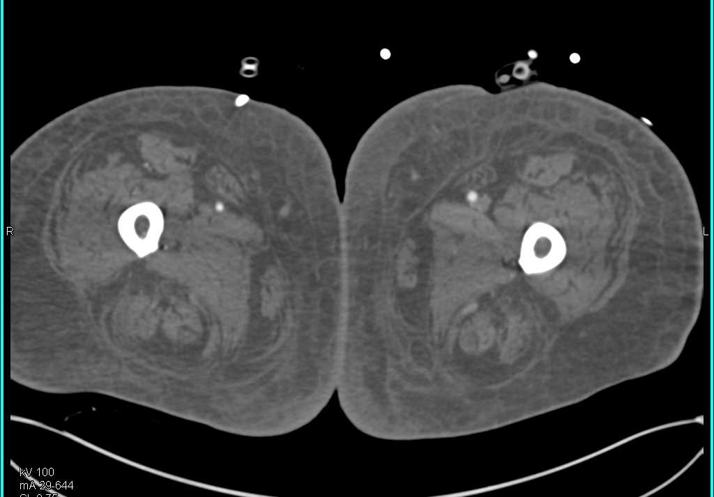 Clot in Right Popliteal Artery on DE Runoff - CTisus CT Scan