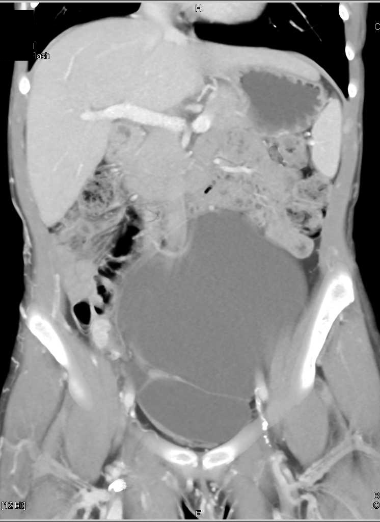 High Grade Stenosis of the Right External Iliac Artery - CTisus CT Scan