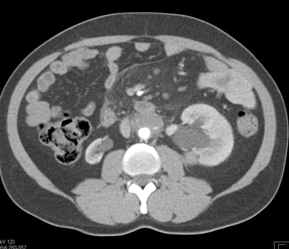 Retroperitoneal Fibrosis Encases the Aorta - CTisus CT Scan