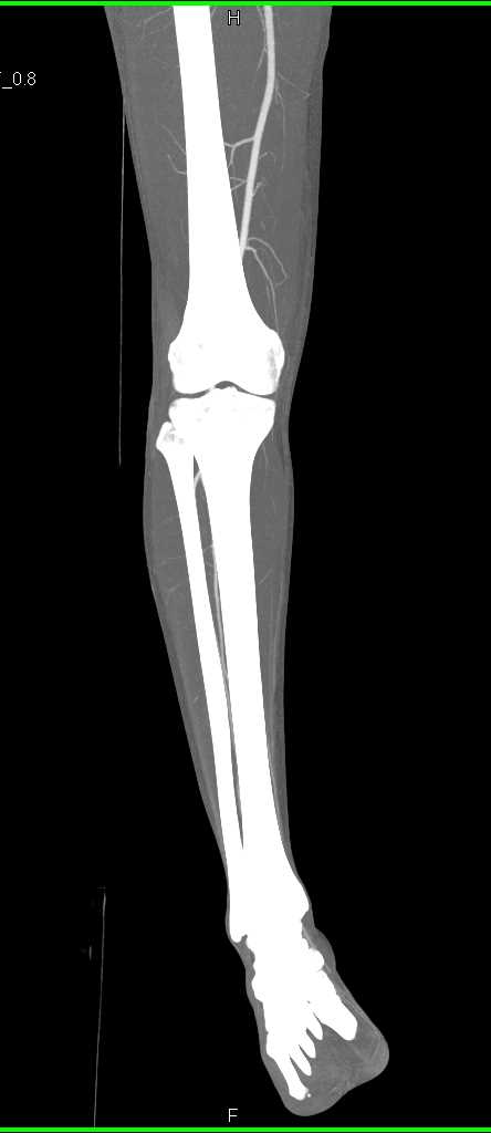 Normal Runoff Vessels in Patient for Graft Harvesting - CTisus CT Scan