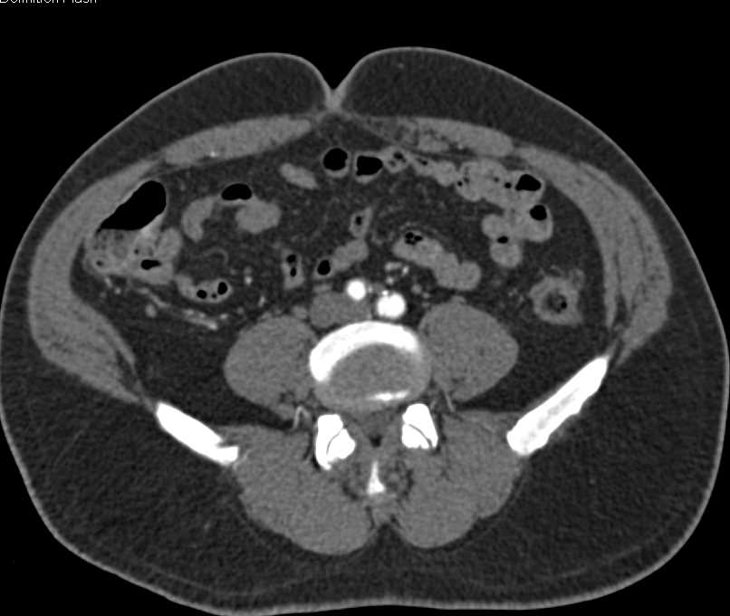 CTA Runoff with Occluded Left Superficial Femoral Artery (SFA) and Peripheral Vascular Disease (PVD) Beneath Knee - CTisus CT Scan