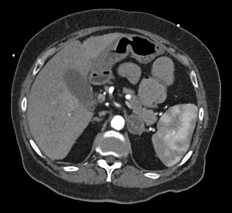 Vascular Disease with Left Common Iliac and Superficial Femoral Artery (SFA) Occlusion in Patient with Extensive Disease - CTisus CT Scan