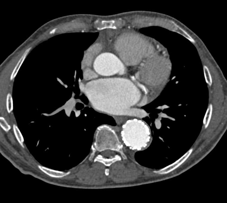 Endovascular Stent with a Type 2 Endoleak - CTisus CT Scan