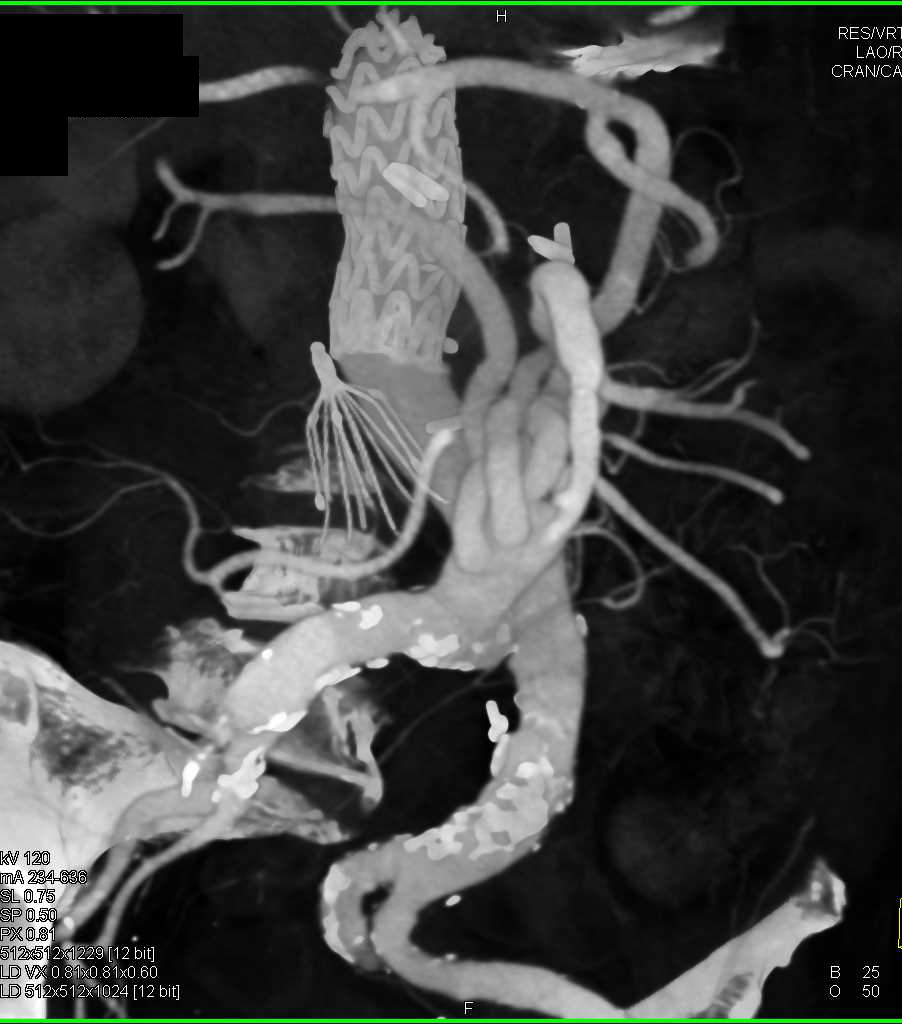 Endovascular Stent and Reimplanted Mesenteric Arteries - CTisus CT Scan