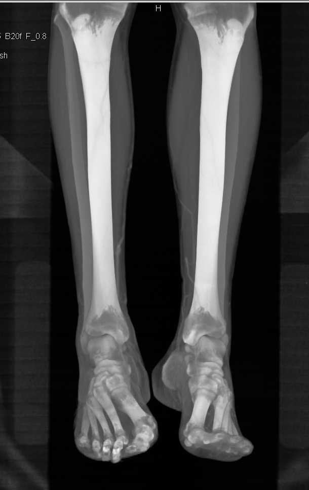 Occluded Right Common Iliac Artery and Peripheral Vascular Disease (PVD) - CTisus CT Scan