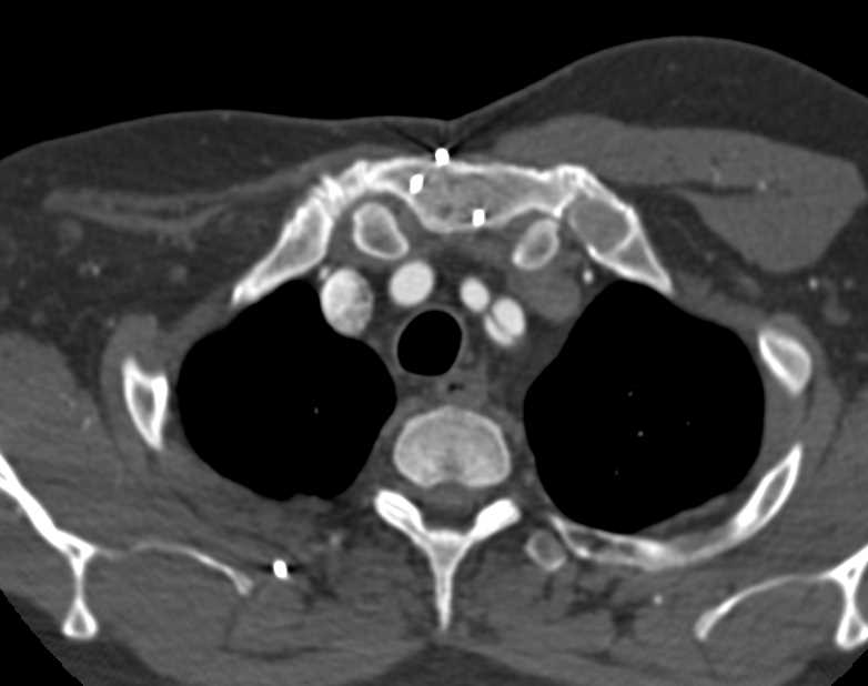 Type B Aortic Dissection - CTisus CT Scan