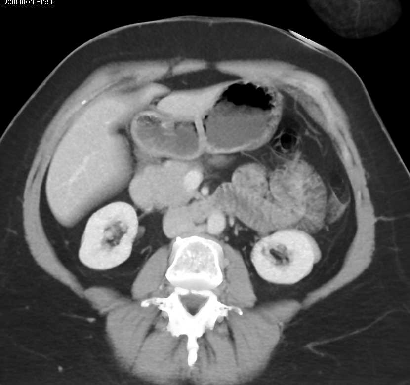 Endovascular Stent Failure on 3D CT - CTisus CT Scan