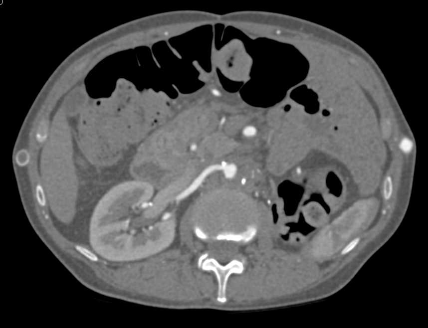 Occlusion Infra-Renal Aorta with Collaterals - CTisus CT Scan