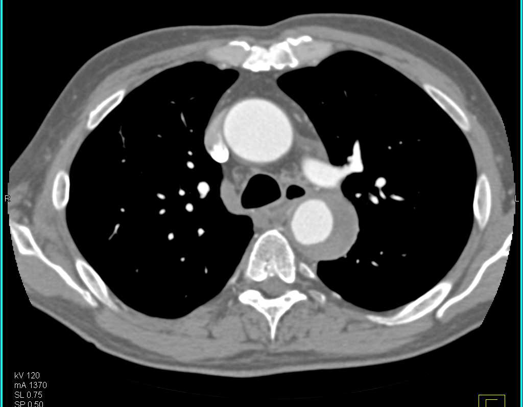 Intramural Hematoma Descending Thoracic Aorta - CTisus CT Scan