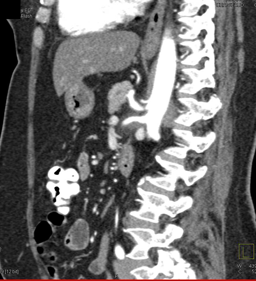 Media Arcuate Ligament Compression due to Shunt - CTisus CT Scan