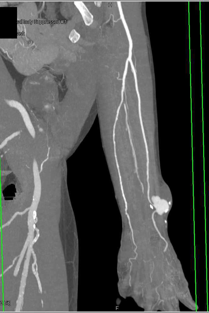 Post Traumatic Vascular Malformation - CTisus CT Scan