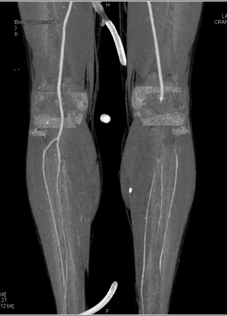 Occluded Left Popliteal Artery by Clot - CTisus CT Scan