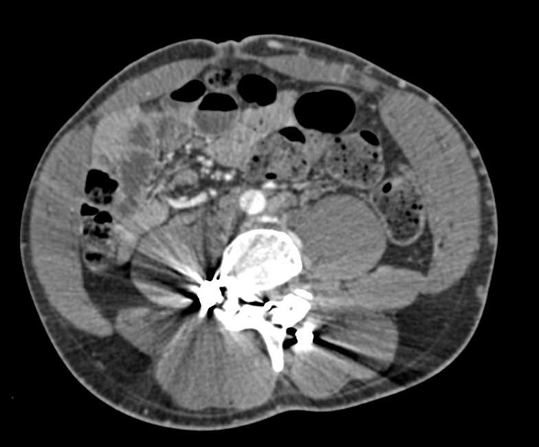 Runoff Studies with Occluded Left Arterial Graft - CTisus CT Scan