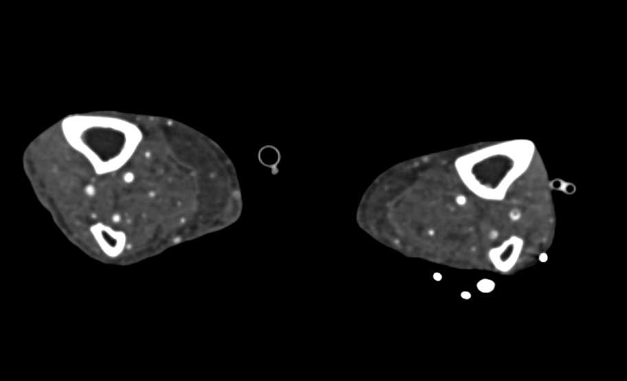 Popliteal Artery Occlusion in a Patient with a Renal Transplant and Known Peripheral Vascular Disease - CTisus CT Scan