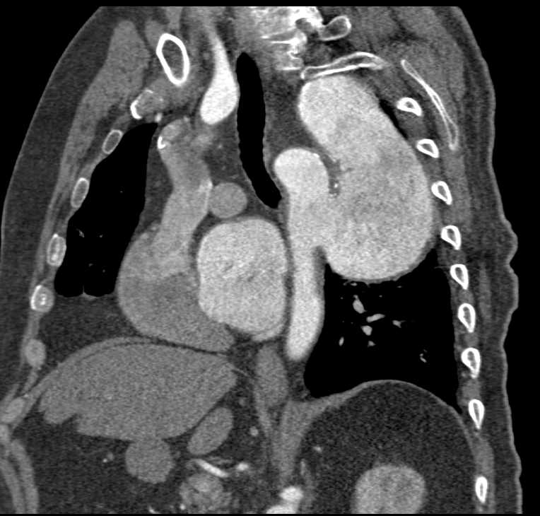 Aortic Aneurysm with Dissection - CTisus CT Scan