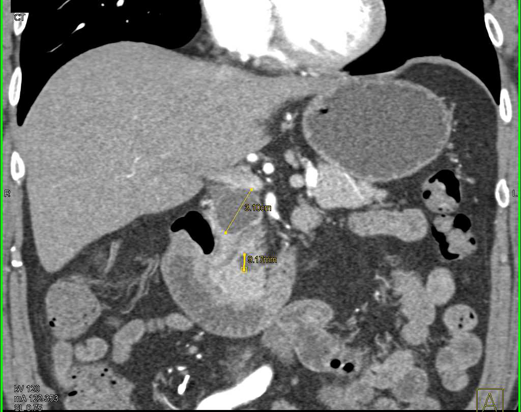 Intraductal Papillary Mucinous Neoplasms (IPMNs) and Aortic Artery Repair - CTisus CT Scan