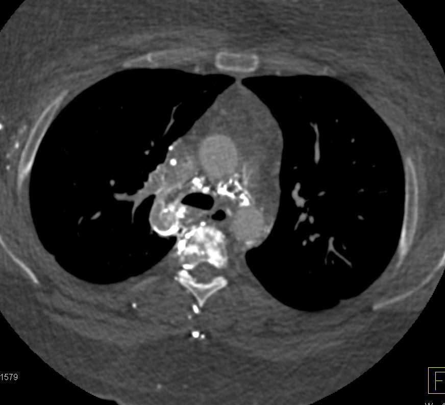 Superior Vena Cava (SVC) Thrombus with Extensive Collaterals - CTisus CT Scan