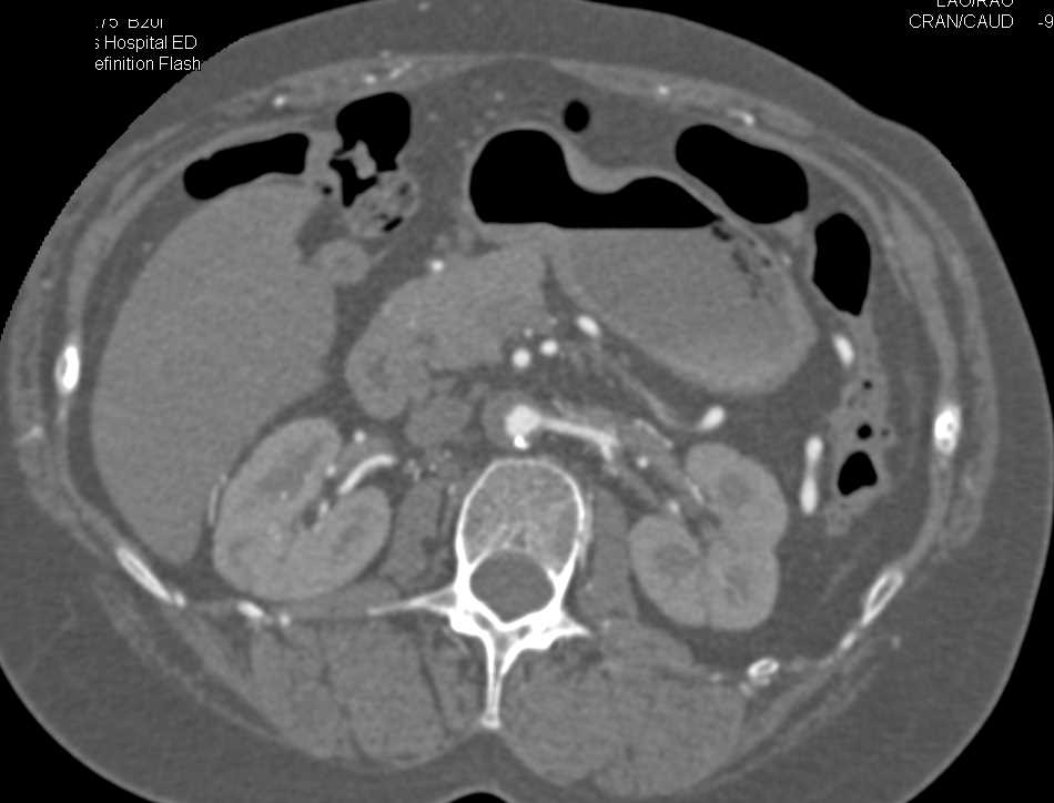 Chronic Occlusion of the Abdominal Aorta with Multiple Collaterals - CTisus CT Scan