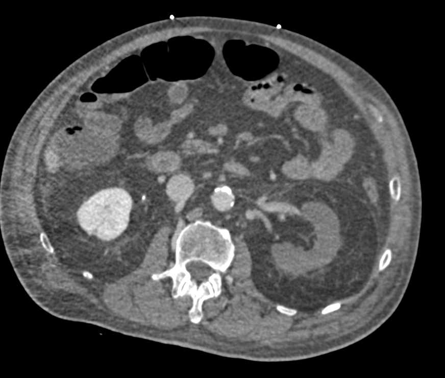 Occlusion Left Common Iliac Artery and Left Renal Artery - CTisus CT Scan