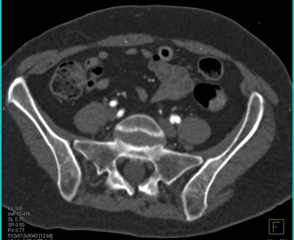 Peripheral Vascular Disease - CTisus CT Scan