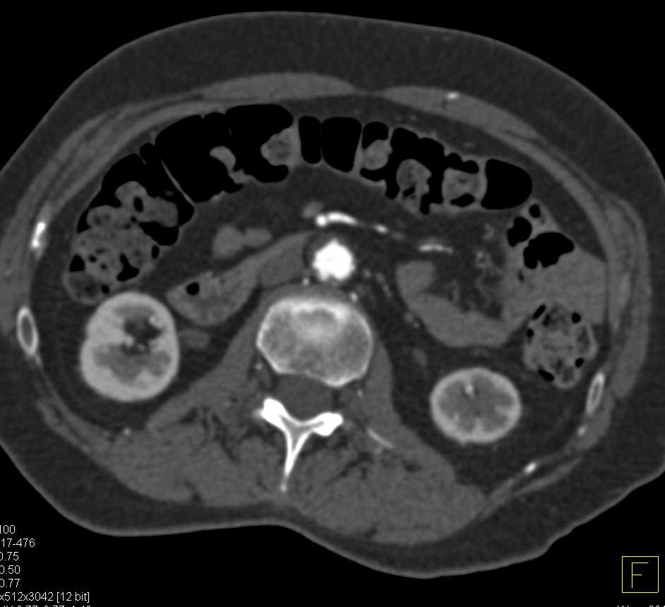 Peripheral Vascular Disease in the Left Lower Extremity - CTisus CT Scan