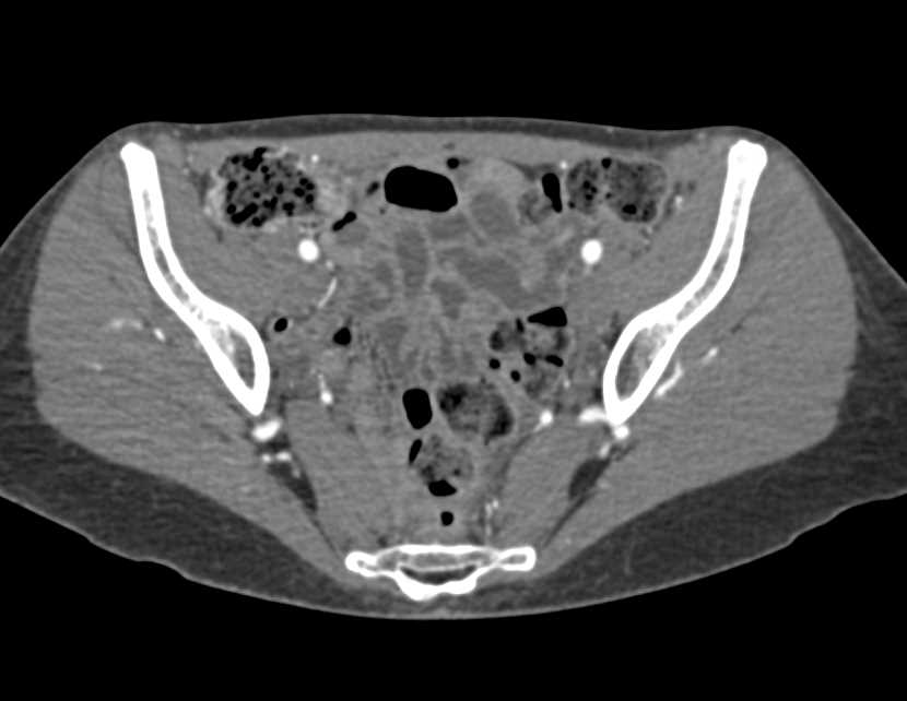 Vascular Mapping of the Pelvis and Upper Thigh - CTisus CT Scan