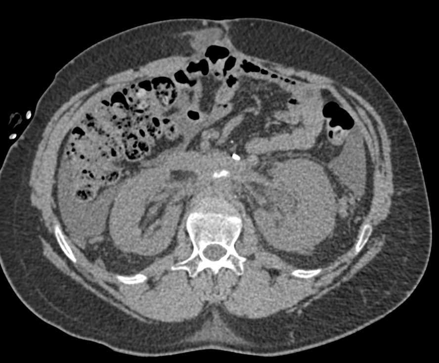 Lymphangiogram with Retroperitoneal Fibrosis - CTisus CT Scan