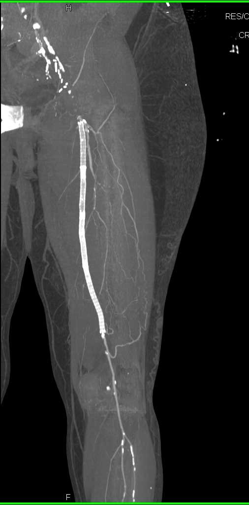 Occluded Left Femoral Artery with Stent Graft - Vascular Case Studies