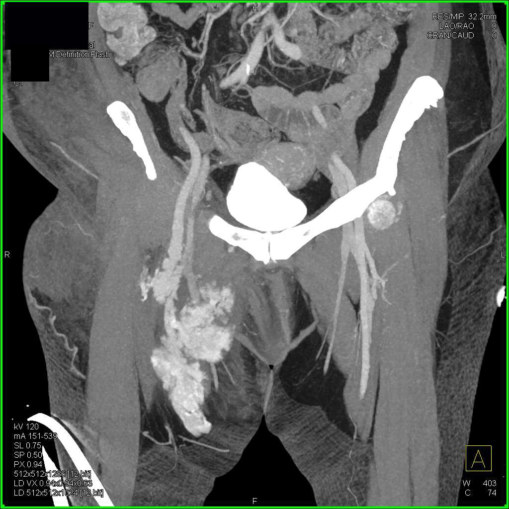 Active Bleed Right Superficial Femoral Artery (SFA) with Thigh Hematoma - CTisus CT Scan