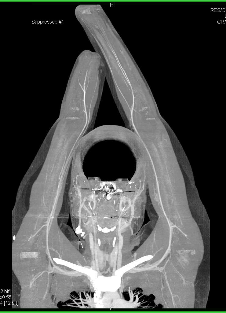 Preoperative Planning for a Hand Transplant - CTisus CT Scan