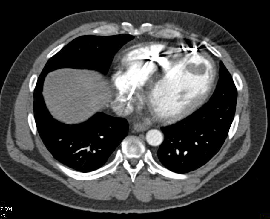 CTA Runoff with Peripheral Vascular Disease - CTisus CT Scan