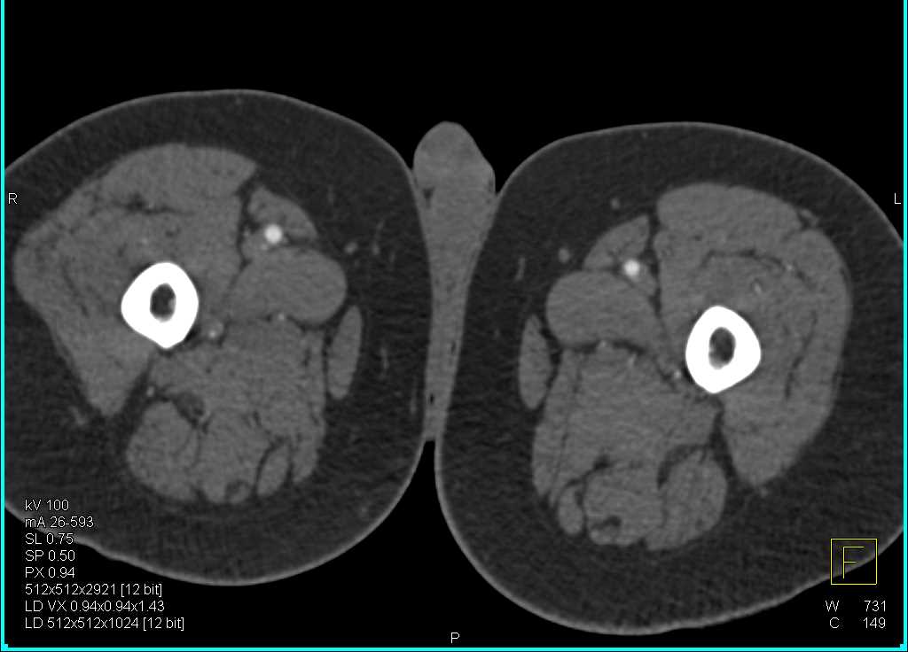 CTA Runoff with Left Superficial Femoral Artery (SFA) Occlusion - CTisus CT Scan