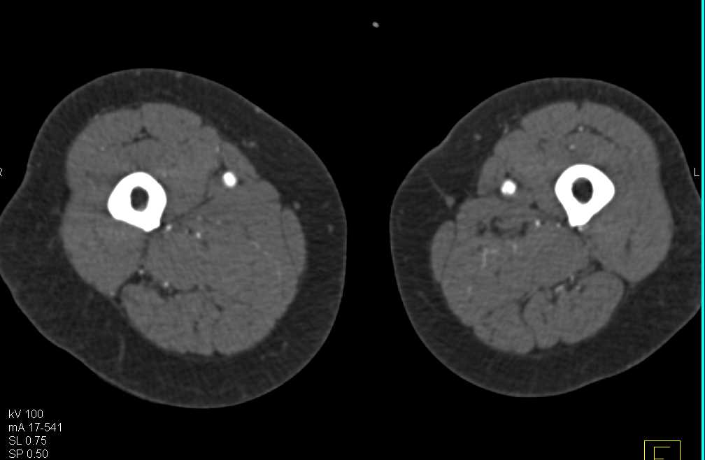 CTA Runoff with Left Superficial Femoral Artery (SFA) Occlusion and Peripheral Vascular Disease (PVD) - CTisus CT Scan