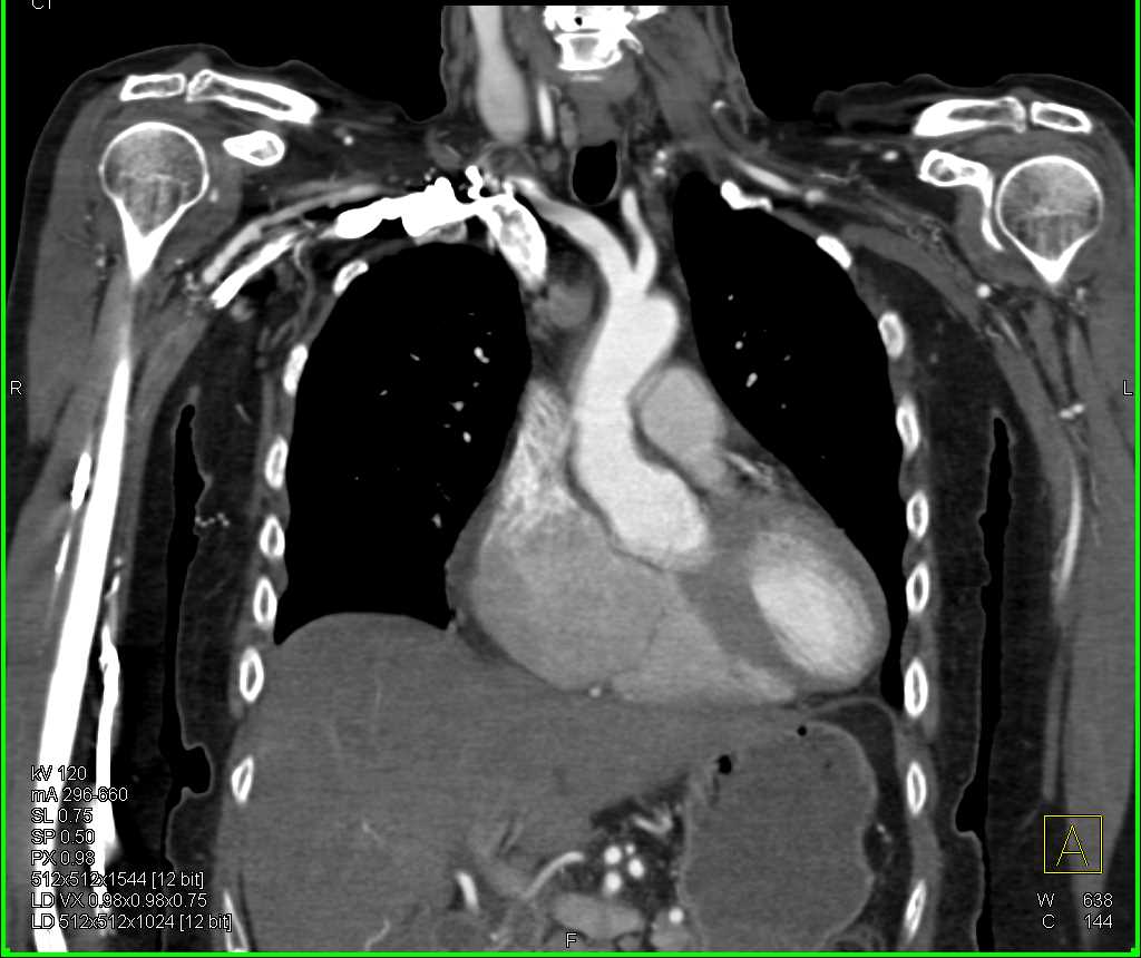 Type B Dissection with Right Brachial Artery Occlusion - CTisus CT Scan