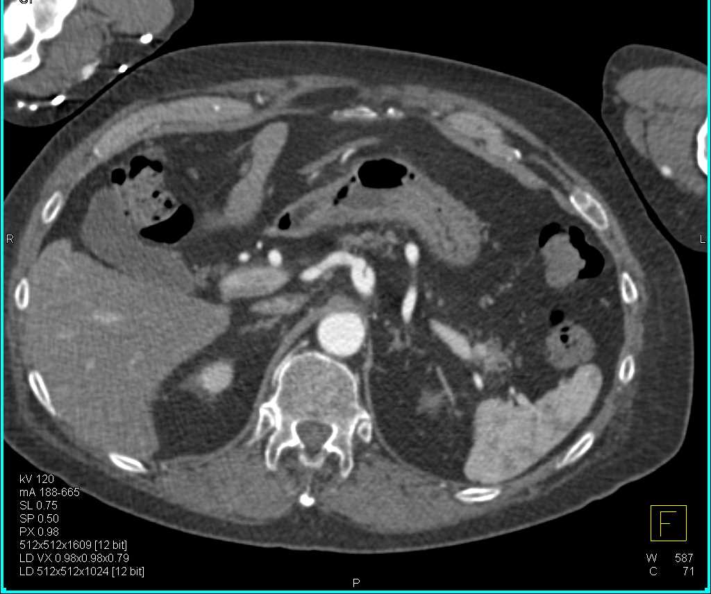 Focal Dissection in the Celiac Artery - CTisus CT Scan