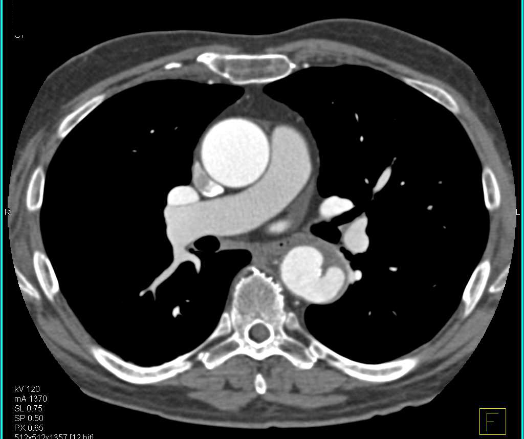 Ulceration Descending Thoracic Aorta - CTisus CT Scan