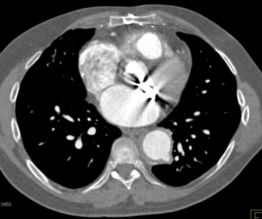 Type A Dissection - CTisus CT Scan