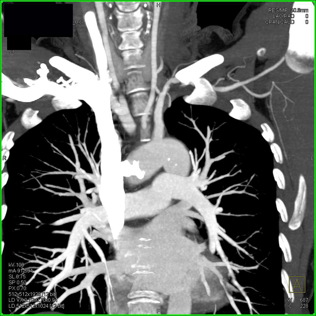 Takayasu's Arteritis Involves Left Subclavian Artery and Other Branch Vessels - CTisus CT Scan