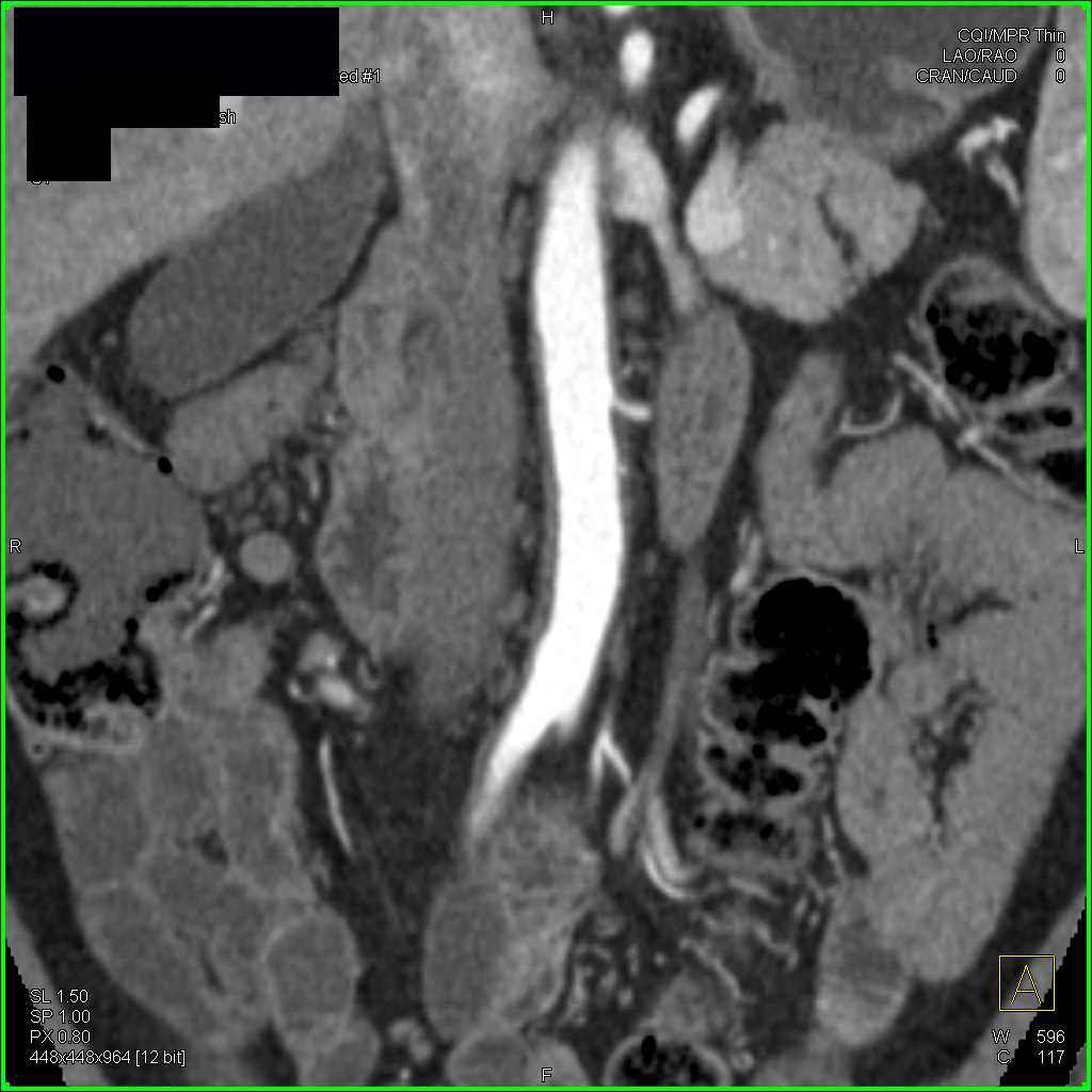 Takayasu's Arteritis Involves Left Subclavian Artery and Other Branch Vessels - CTisus CT Scan
