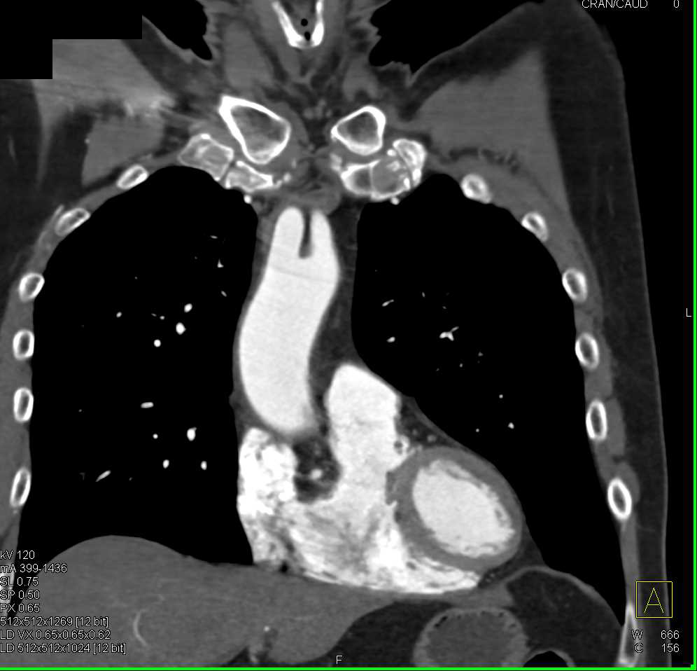 Ulcerating Plaque Aortic Arch - CTisus CT Scan