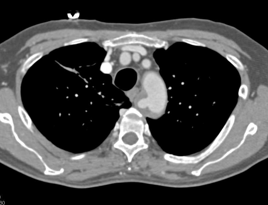 Ulcerating Plaque Aortic Arch - CTisus CT Scan