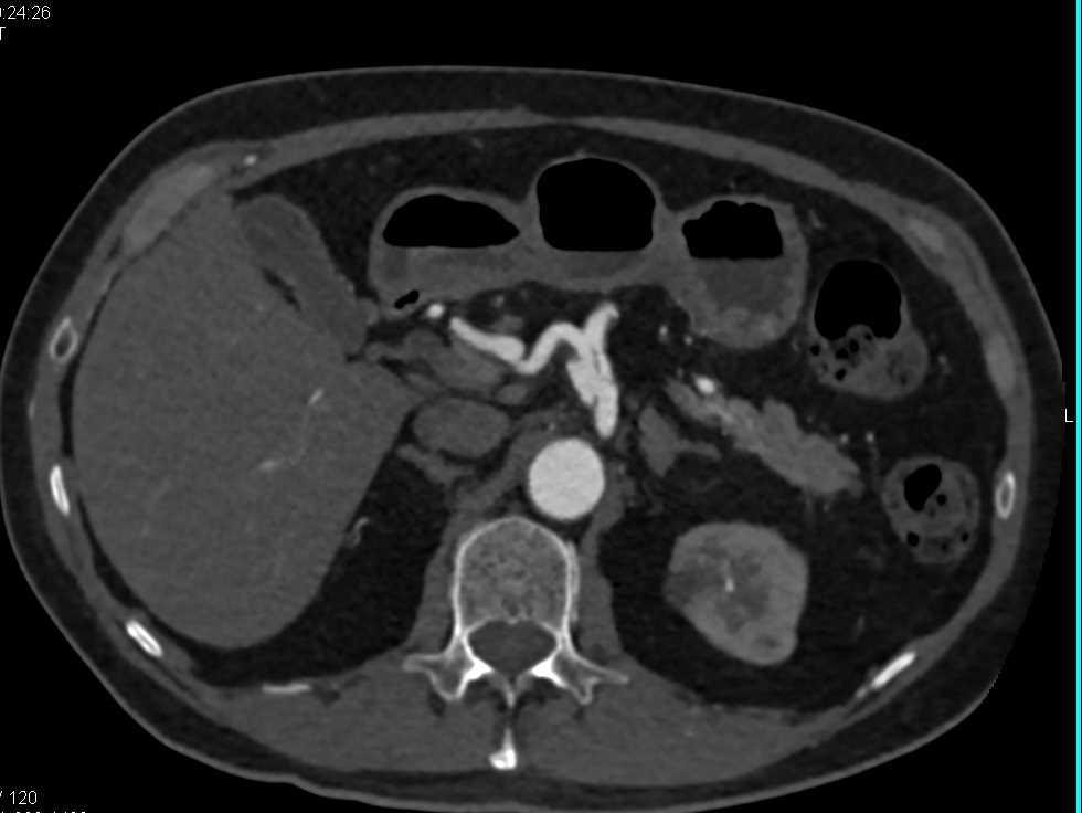 case body note 5 Dissection Vascular Celiac  Artery Vasculitis and Case