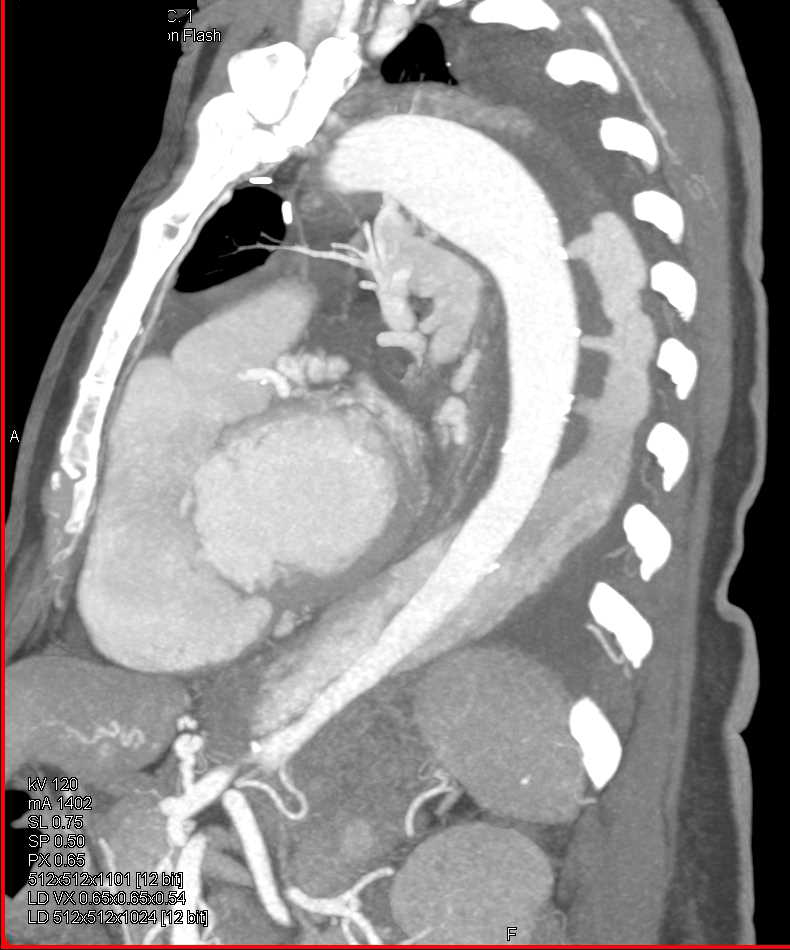 Pancreatic Cancer with Pulmonary Emboli (PEs) - CTisus CT Scan