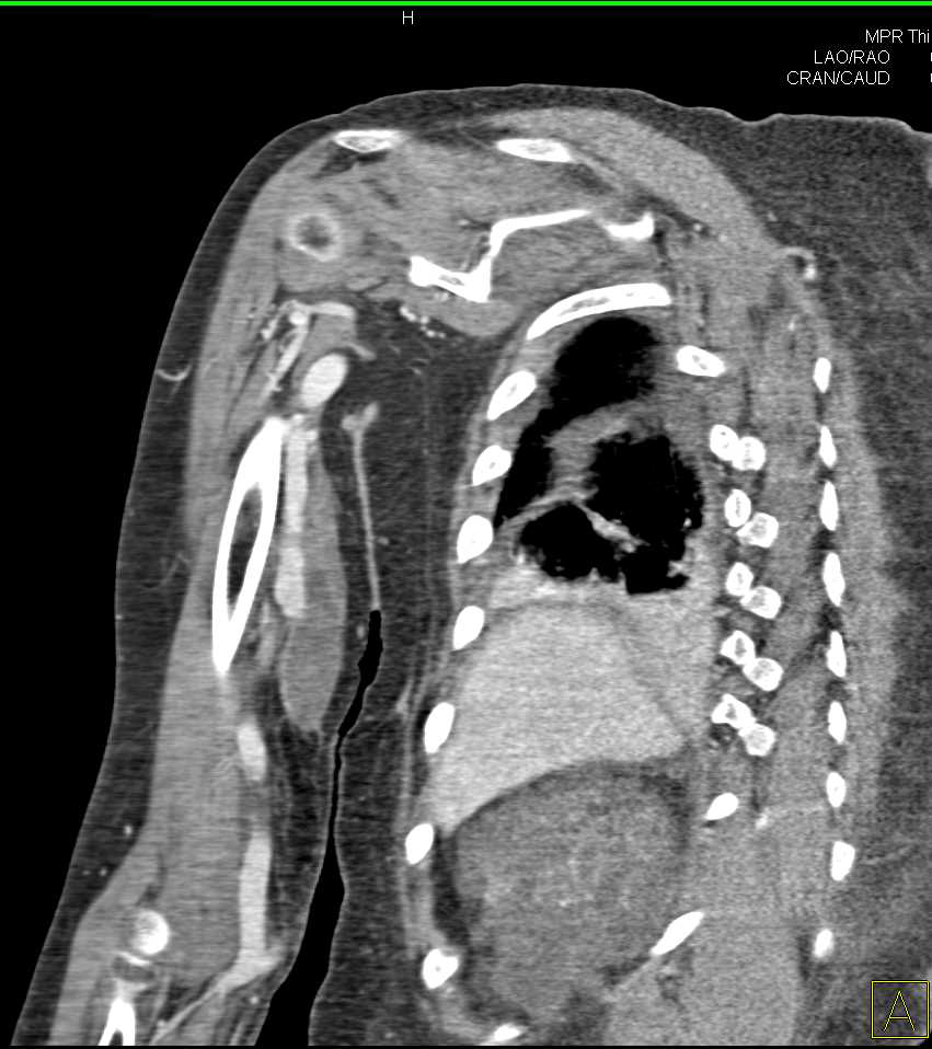 Arteriovenous (AV) Fistulae Arm in Patient Who Is a Renal Dialysis Patient - CTisus CT Scan