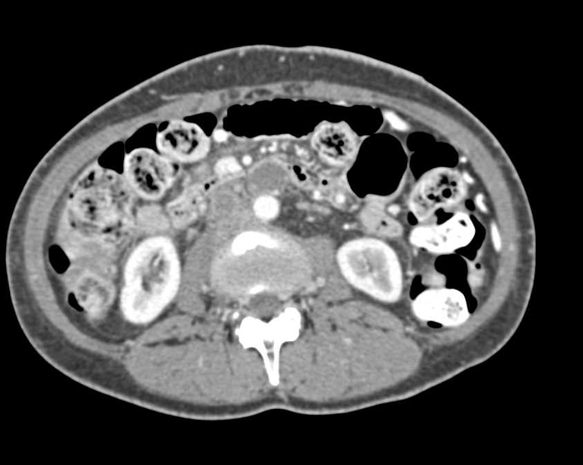 Tumor Extension with Inferior Vena Cava (IVC) Involvement - CTisus CT Scan