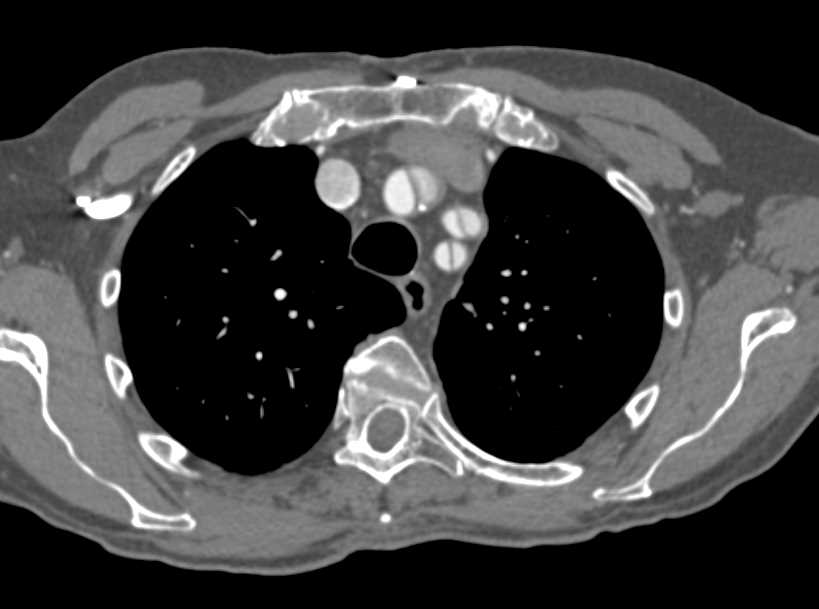 Type A Dissection Involves the Branch Vessels off the Arch - CTisus CT Scan