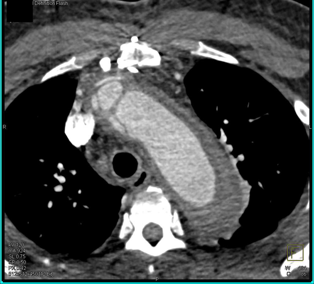 Aortic Dissection with Intramural Hematoma - CTisus CT Scan