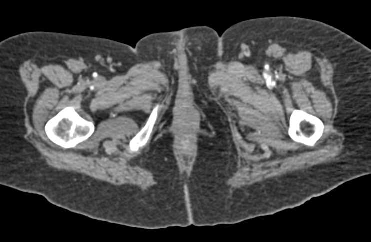 CTA with Vascular Patency - CTisus CT Scan