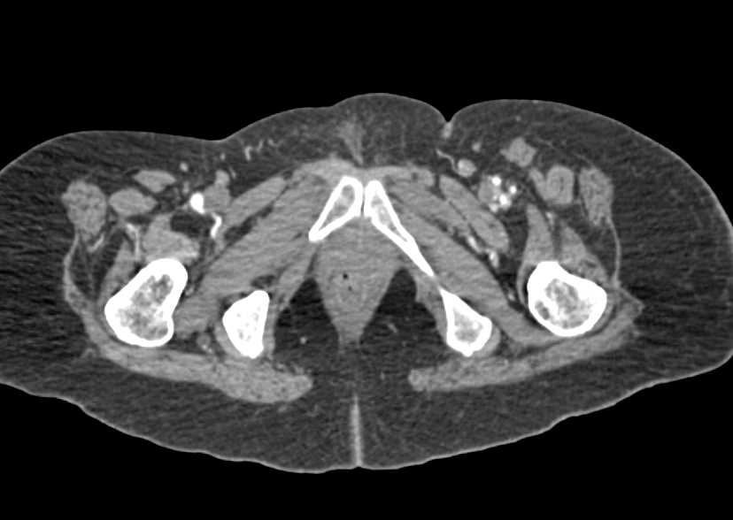 CTA with Dual Energy Bone Removal - CTisus CT Scan