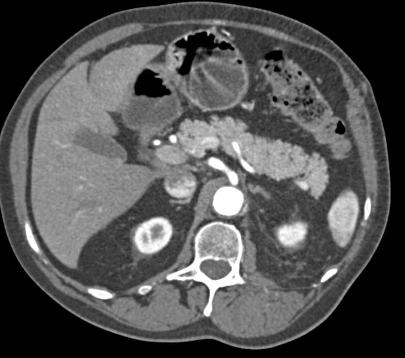 Fem-Fem Bypass Graft with Left Superficial Femoral Artery (SFA) Occlusion - CTisus CT Scan